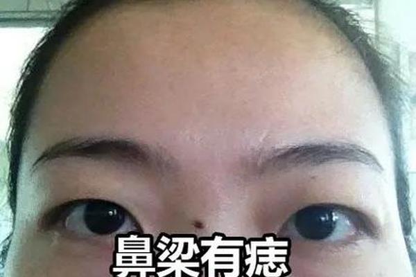 鼻子中间的痣 痣相_鼻梁中间的痣是什么痣