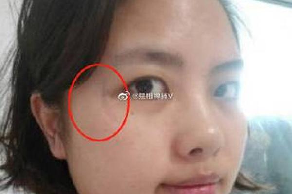 眼尾长痣相 为什么眼尾突然长个痣 眼尾长痣相 为什么眼尾突然长个痣