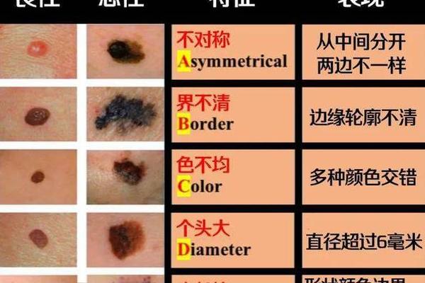 痣相不完全可信 三种痣哪种最容易恶变