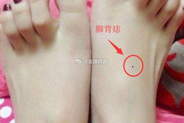 男人右脚外侧痣相—右脚侧面有痣代表什么
