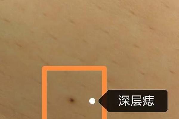 破了相可以随便点痣不—点痣会出人命吗