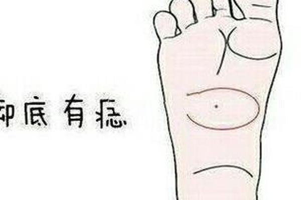 脚底板有痣相(脚底板长痣图解大全)