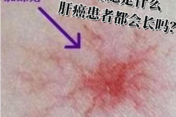 什么痣和蜘蛛痣相;什么叫蜘蛛痣图片大全