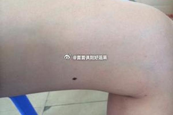 大腿根相痣 大腿根长痣代表什么