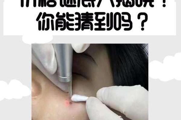 相城医院点痣多少钱一颗-医院激光点痣多少钱