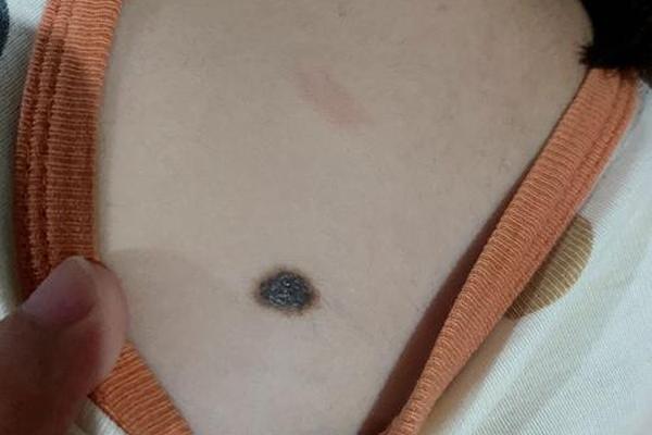 痣相小女孩、每个小女孩身上都有痣吗