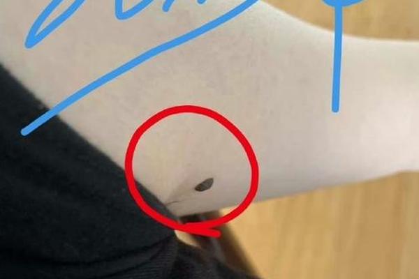 腋窝下痣相 腋窝痣相图解大全