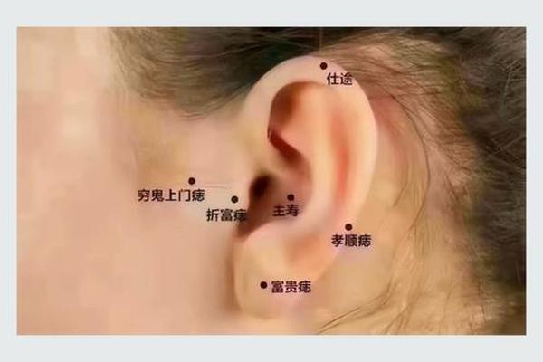 痣相 耳旁,耳朵有痣相图解