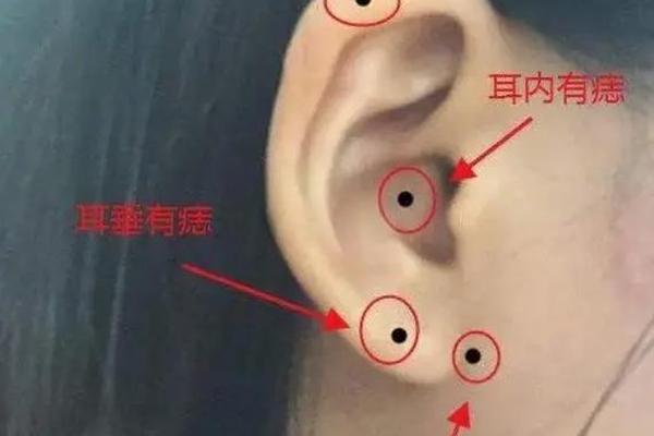 嘴边上的痣相(耳轮上有痣图解)