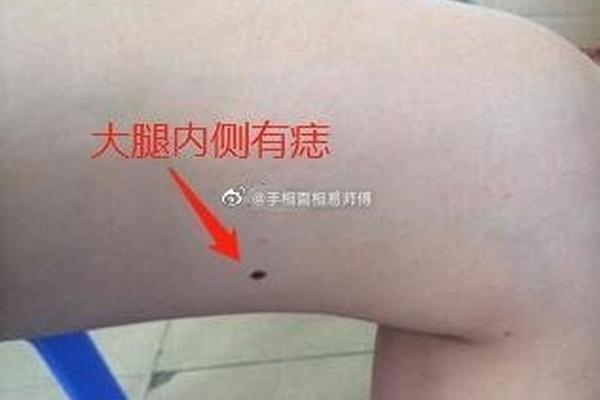 大腿内侧痣相男—右腿长痣