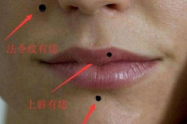 上唇痣相解析;痣在上嘴唇上是什么痣