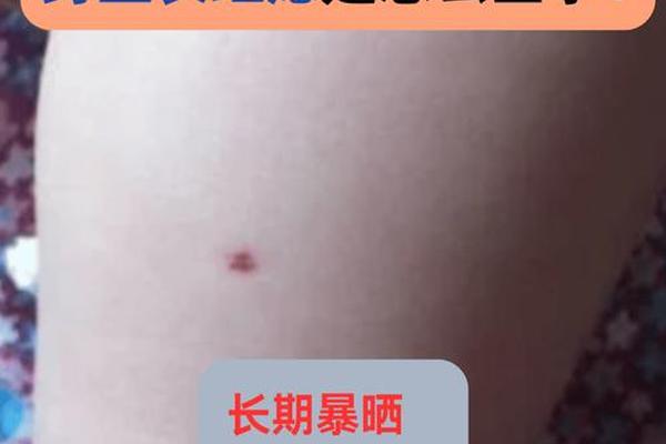 女子身红痣相 女人有红痣代表什么