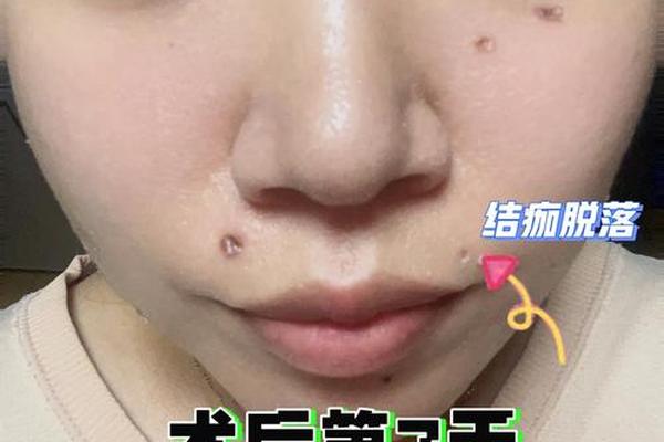 点痣后影响痣相吗-点痣后痂老不掉 怎么办