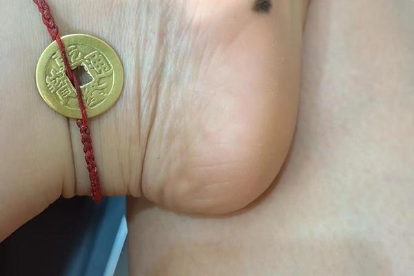 痣相女人脚部痣相图解 女人右脚底有痣