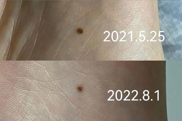 痣相脚长红痣;脚板长红痣代表什么意思