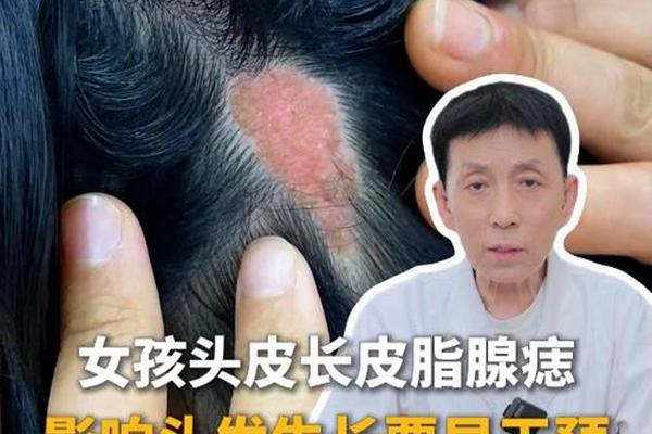 头相痣的图片大全女人(头皮痣图片大全)