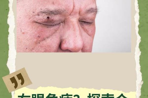 眼角长颗痣典型克夫相,眼角有痣的人命运 眼角长颗痣典型克夫相,眼角有痣的人命运