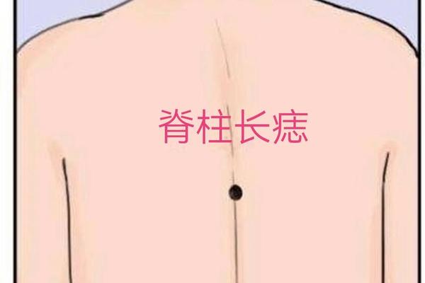 背后长痣相、背部痣相图解读