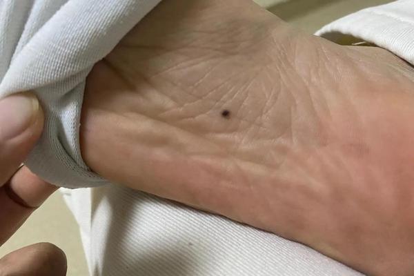痣相裆部,大腿根裤裆处有痣