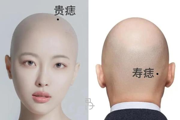 麻衣相头顶长痣-头顶长红痣有什么说法