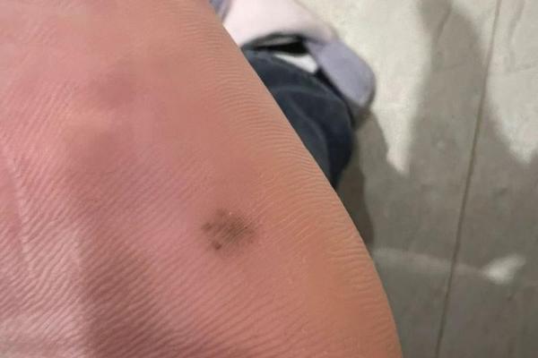 女脚后跟痣痣相-脚后跟底有痣图解