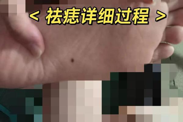 脚底痣痣相_脚底痣图片大全图解