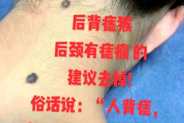 后颈长痣麻衣神相_后脖颈有颗痣好不好