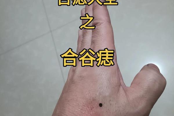 手背痣相解析、手背痣相图解大全图解 手背痣相解析、手背痣相图解大全图解