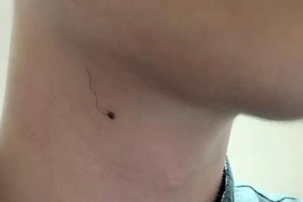 男人脖子右侧 痣相;右肩有痣的男人命运