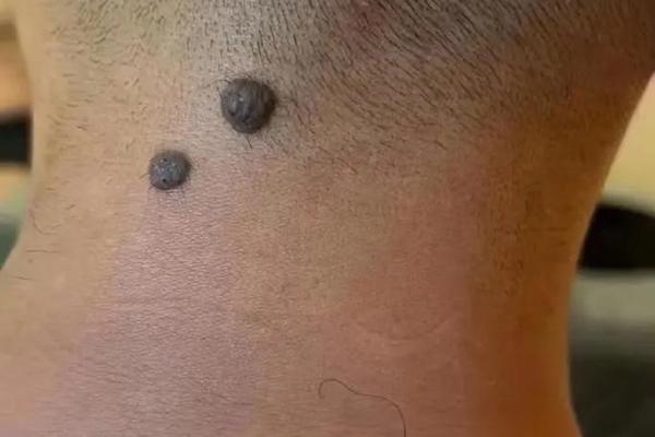 背部痣相大全 后背有痣命苦