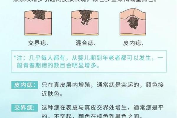 痣与周围皮肤相平 和皮肤一样平的黑点是痣吗