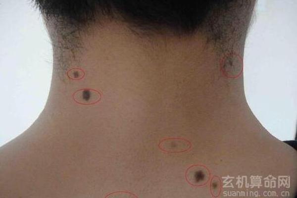 倪海厦讲后脖有痣相—为什么大多数人脖子后面有痣