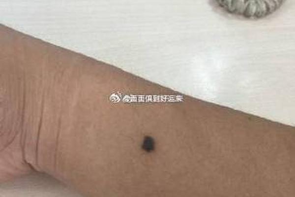 手腕痣相大全 手腕有痣是什么意思