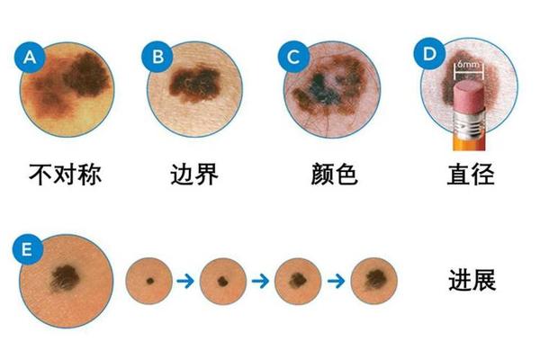 色素痣和什么相鉴别图片(色素痣是什么样的图片 初期) 色素痣和什么相鉴别图片(色素痣是什么样的图片 初期)