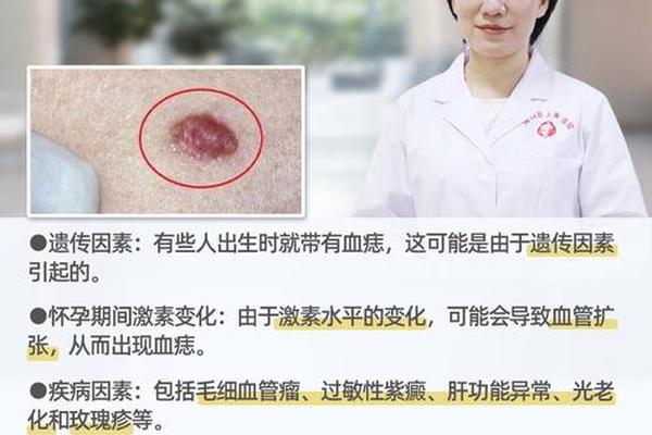 肝胆相照血痣(身上有血痣是肝脏的问题吗)