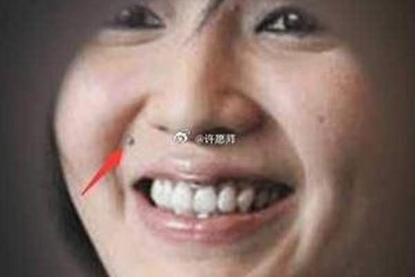 女左法令纹痣痣相 女人左侧法令纹有痣主富贵