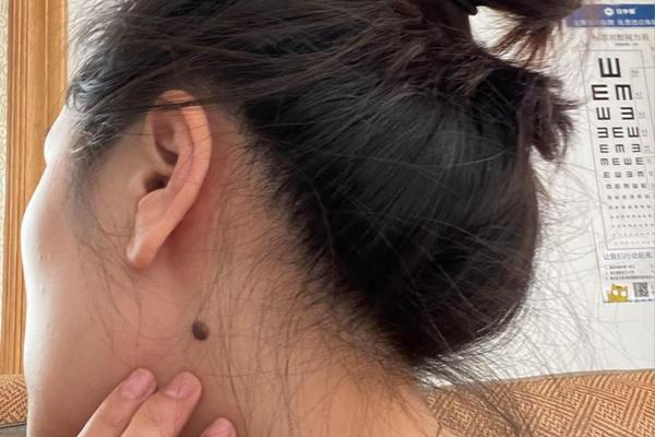 痣相女脖子中间—脖子痣
