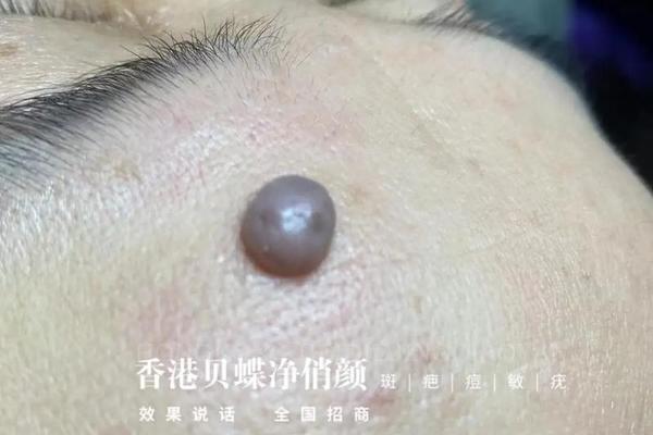 痣相长肉芽_黑痣长肉芽什么原因