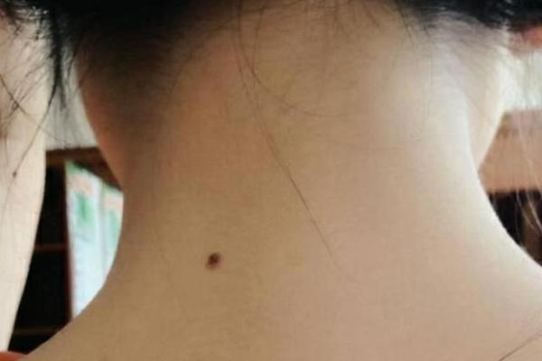 女性脖子后面痣相_脖子后面长痣好不好