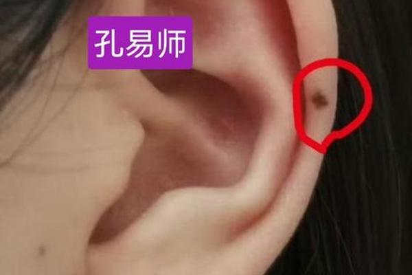 耳相长痣图—面相长痣的大图片