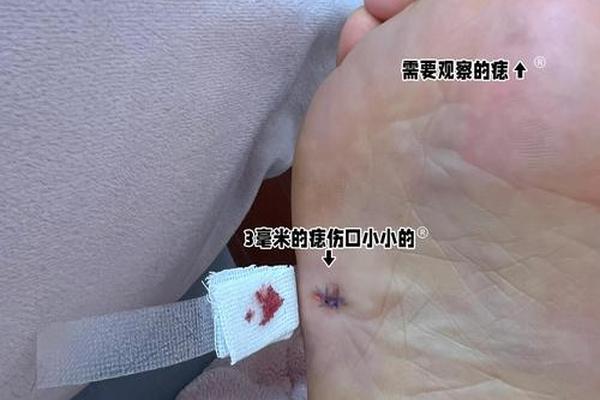 脚底下有痣的相,脚底痣相图解