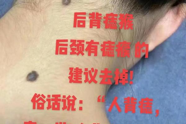 背后面痣相_后背有痣命苦