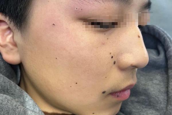 点完痣痣相就破了么_痣如果挑破了会怎么样