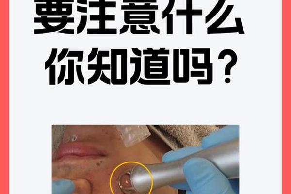 淮北相山哪里祛痣好—淮北人民医院可以激光点痣吗