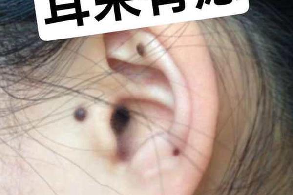耳相痣;痣相大全详解