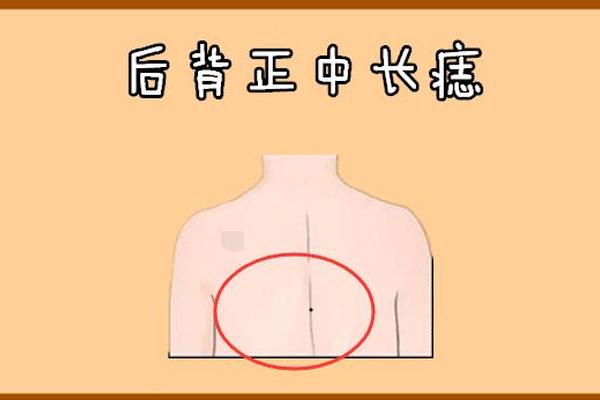 相法背部有痣代表什么 背部长痣代表什么图解