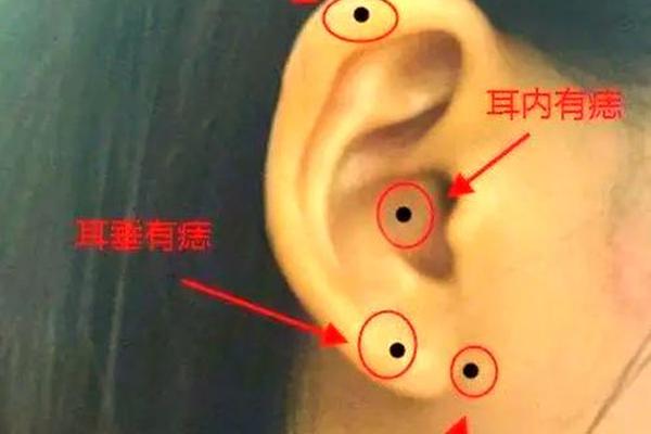 左耳朵下面的痣相_左耳下面长痣代表什么