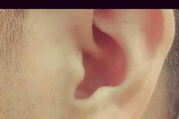 男人耳垂有痣相;高人说耳垂痣