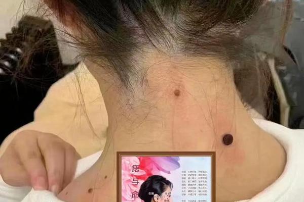 男相脖子长痣(男子脖子痣相图解大全)
