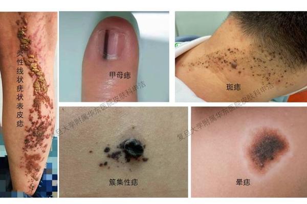 与皮肤相平的痣(跟皮肤一样平的痣叫什么)